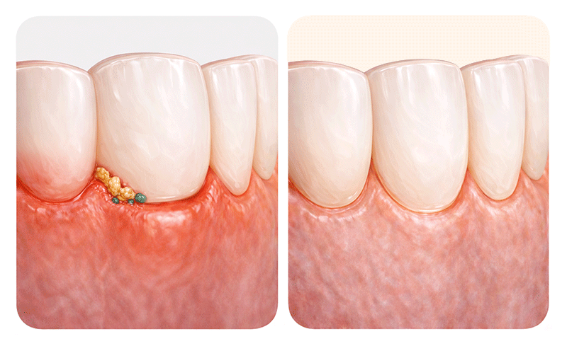 An image showing overcontoured margins at the gumline from excessive no-prep veneers and its side effects