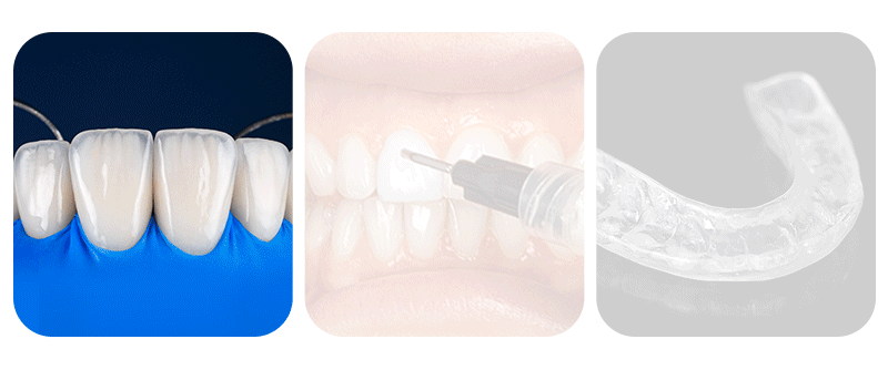 An image showing the dental veneer bonding process