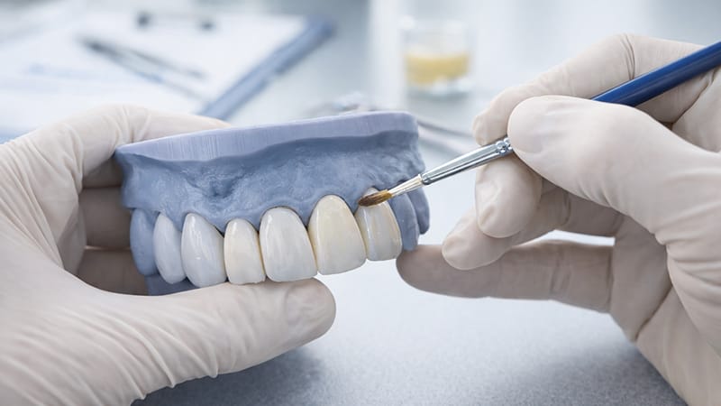 A dental technician performing a layering technique during veneer fabrication