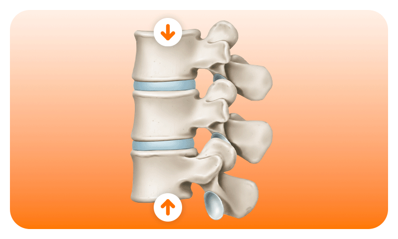 A medical illustration representing a spinal compression fracture