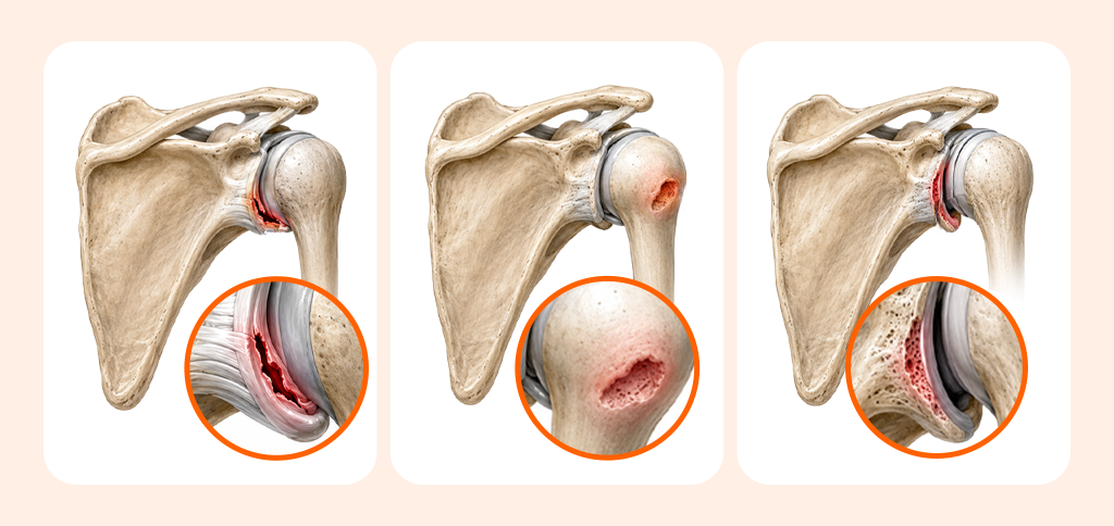 A cross-sectional illustration of the shoulder joint showing Bankart, Hill-Sachs, and glenoid bone loss lesions