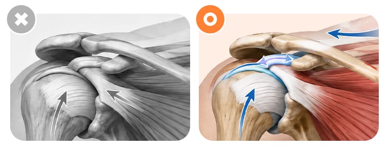 An illustration showing an imbalance among the scapula, humerus, muscles, and tendons
