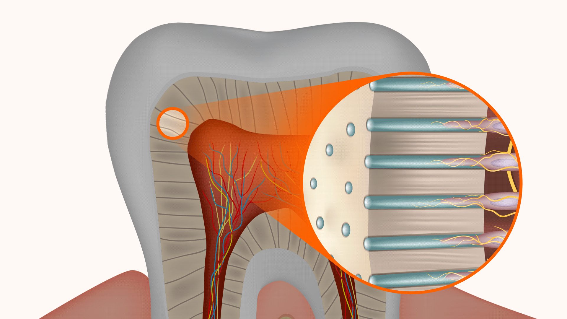 Anatomical illustration of a tooth showing dentin and nerves exposed to external stimuli due to enamel erosion