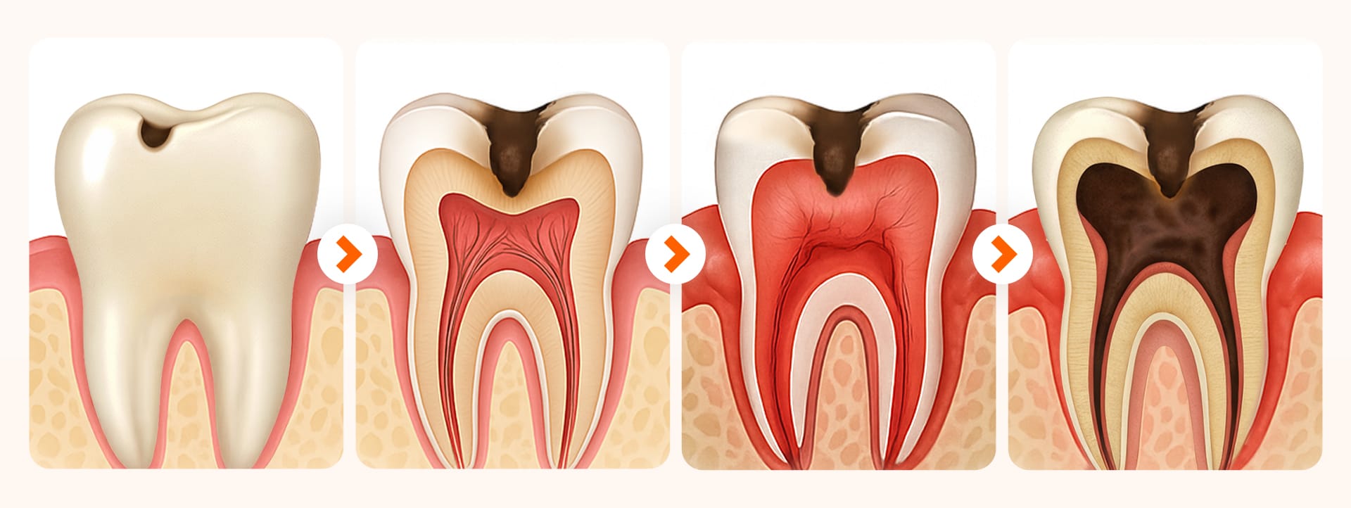 Infographic using tooth cross-sections to visually distinguish the 4 stages of tooth decay progression from enamel to the root end