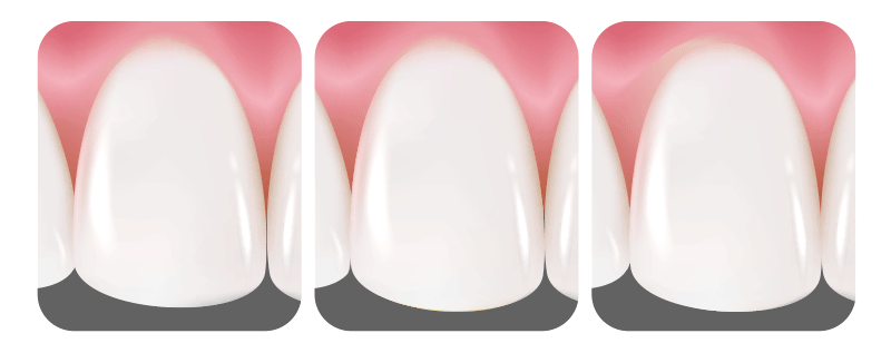 An illustration visualizing three common types of porcelain veneer damage and fractures