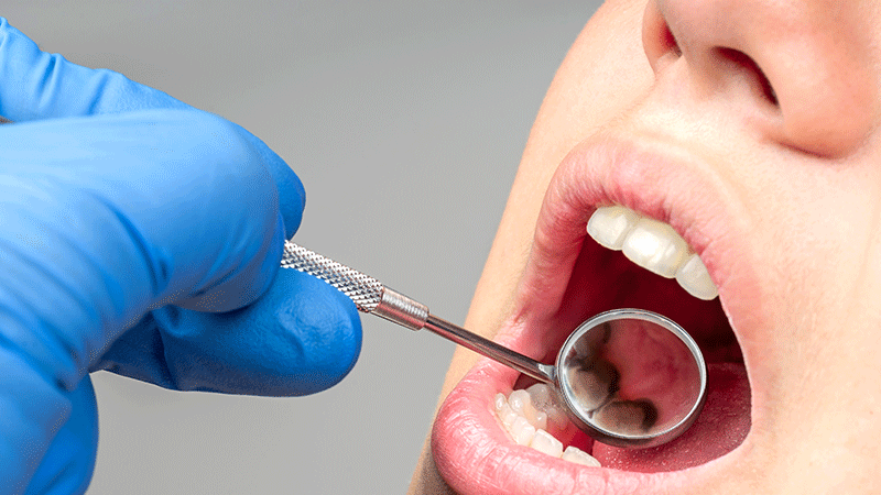 A close-up image showing dark discoloration under a veneer, signaling internal decay and the need for replacement