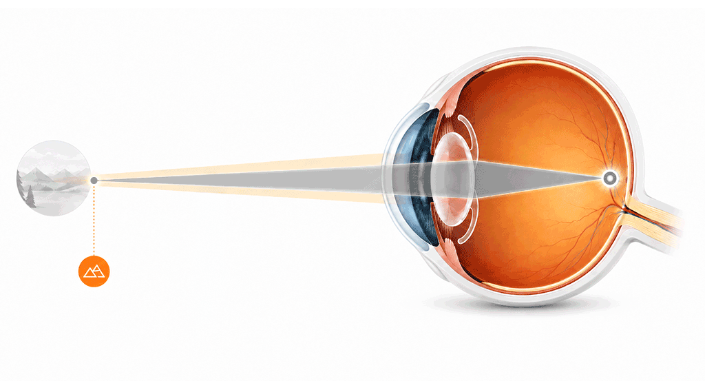 A medical illustration demonstrating the core optical mechanism of a monofocal IOL