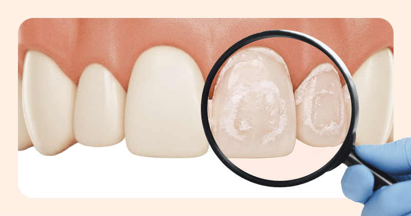 A 3D medical illustration showing a magnifying glass highlighting enamel demineralization on a tooth.
