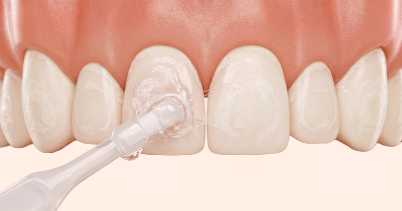 A 3D medical image demonstrating fluoride varnish application on demineralized front teeth.