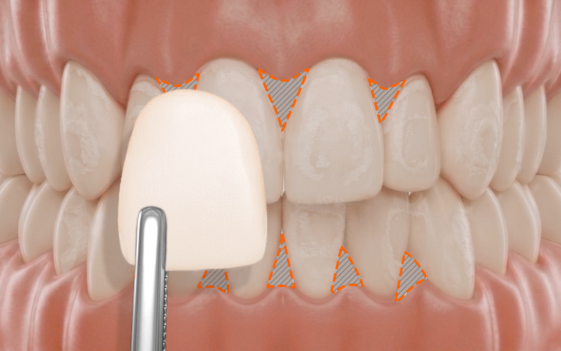 A 3D medical graphic showing a porcelain veneer fit trial on teeth with white spot lesions and black triangles.