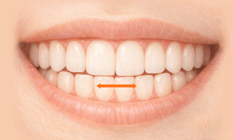 An illustration showing how teeth grinding (bruxism) can fracture porcelain veneers over time