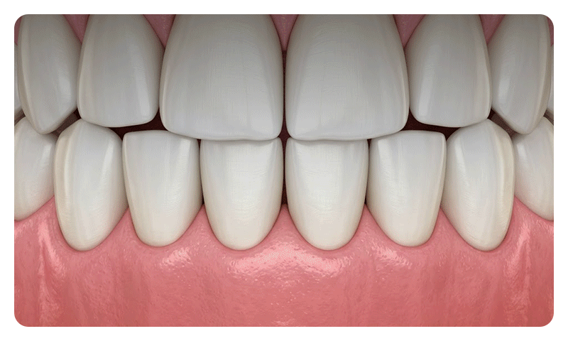 A diagram illustrating progressive gingival recession exposing the tooth root margin