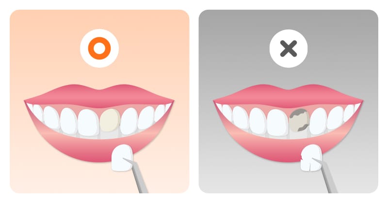 An infographic comparing criteria for veneer rebonding versus full replacement
