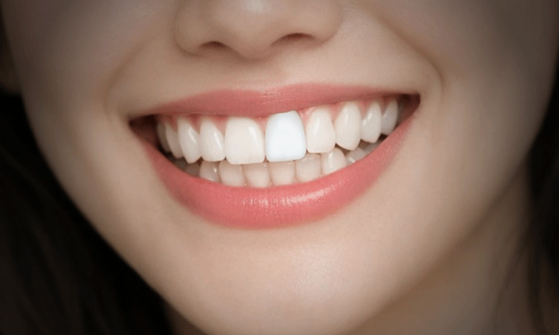 A before-and-after image demonstrating a transformation from a bulky, unnatural veneer to a natural-looking veneer