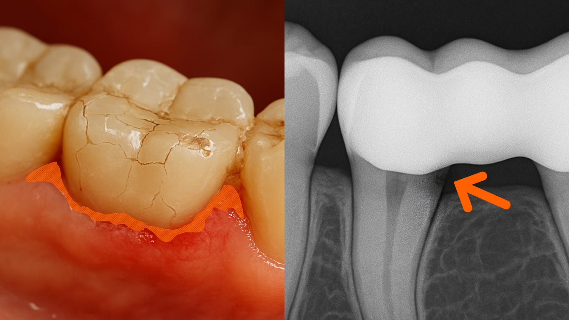 A medical illustration showing bacterial infiltration into gaps beneath an old bridge, causing gum inflammation and tooth decay