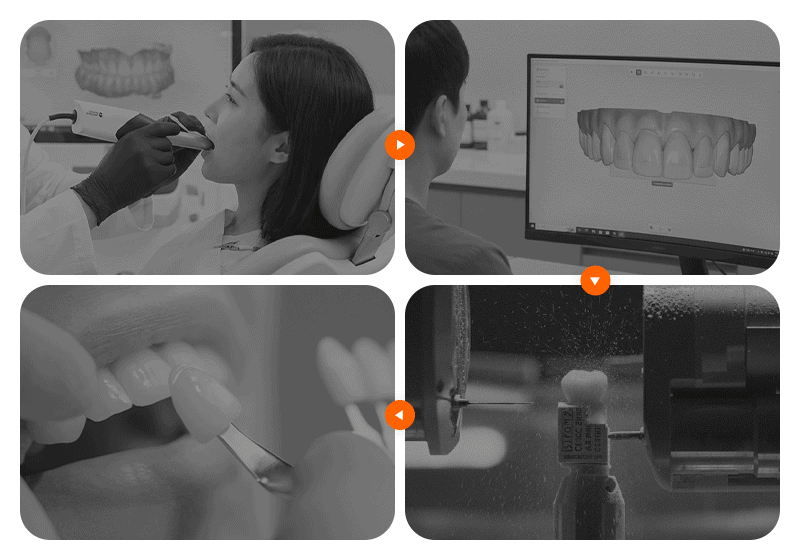 An infographic illustrating the step-by-step process of same-day porcelain veneers
