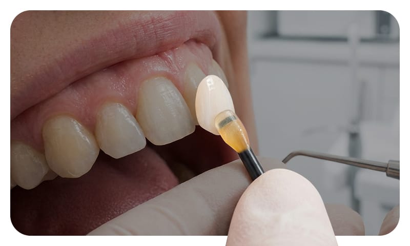 A scene depicting a porcelain veneer being bonded to a healthy tooth surface