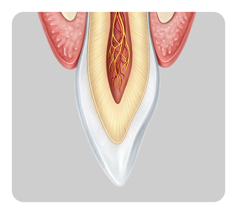 A medical illustration showing porcelain veneer adhesion directly to tooth enamel