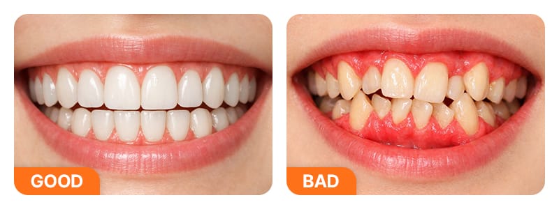 An image comparing suitable versus unsuitable dental conditions for same-day veneers
