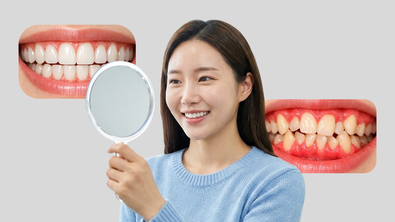 即日完成のワンデイラミネートベニア｜割れやすい？耐久性と成功の条件