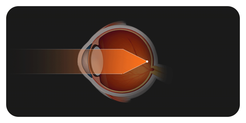 An infographic demonstrating how axial elongation of the eyeball causes nearsightedness