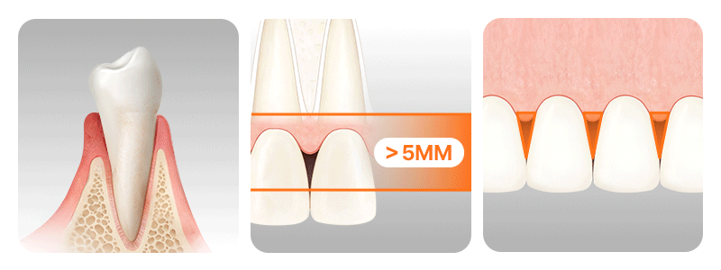 An infographic illustrating 3 major causes of black triangles between teeth