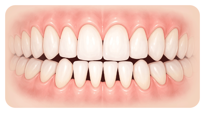 An illustration showing how fully closing black triangles can make teeth unnaturally thick or square