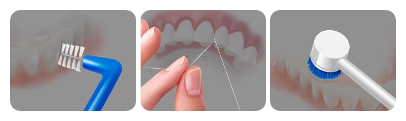 An infographic showing post-treatment maintenance care for black triangle restorations