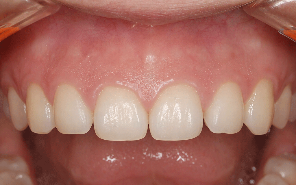 An oral photo showing short clinical crowns due to excessive gingival display