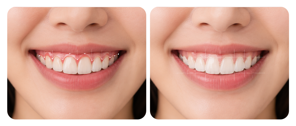 An oral photo highlighting the gingival margin contour and anatomical tooth proportions
