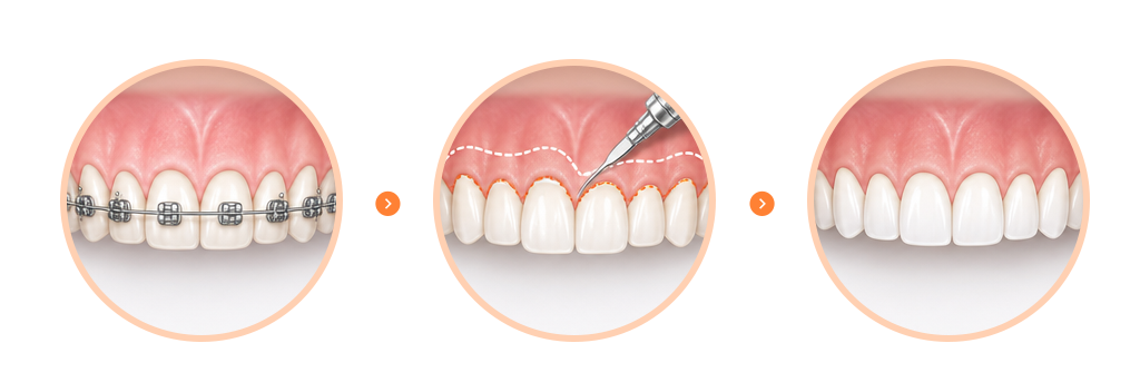 An infographic displaying a combined treatment sequence: orthodontics followed by gingival contouring and porcelain veneers