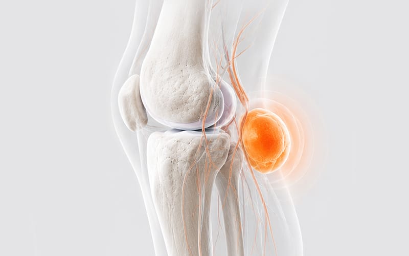 Baker's Cyst: Causes, Testing, and Treatment for a Lump Behind the Knee