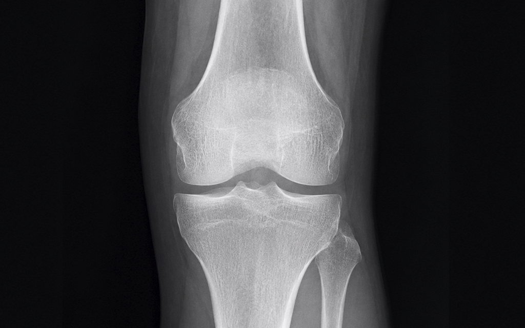 An illustration showing that X-rays alone cannot evaluate ligaments or meniscus tissue