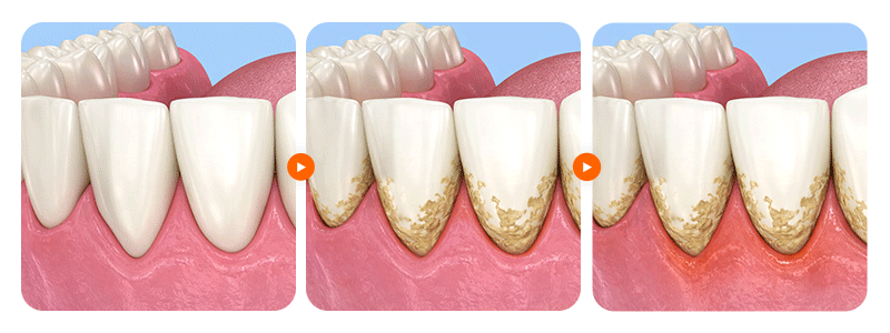 An illustration showing plaque buildup, swollen gums, and tooth decay along the veneer margin between front teeth