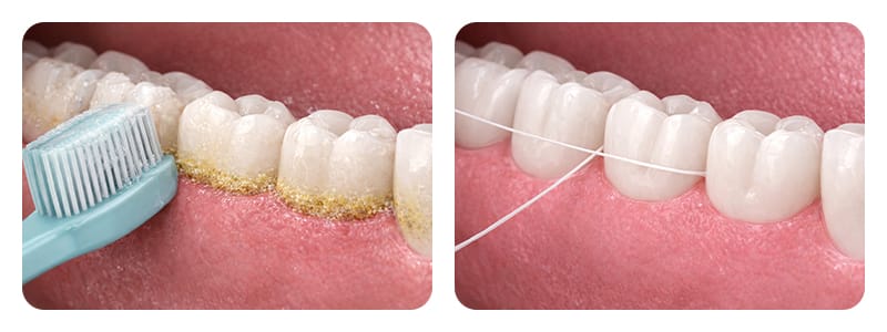 An image comparing remaining calculus levels between brushing alone versus flossing