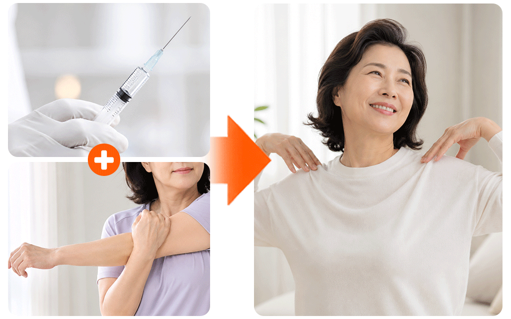 An illustration showing that combining injection therapy with exercise is essential for successful shoulder recovery