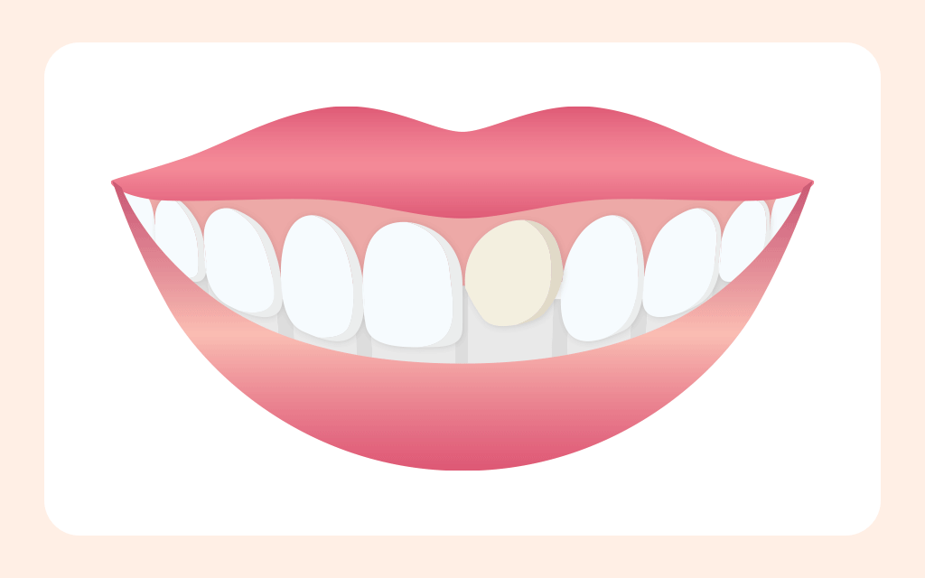 An illustration of a porcelain veneer being bonded to a front tooth