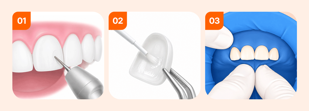 An infographic visualizing 3 steps of a stable veneer bonding procedure