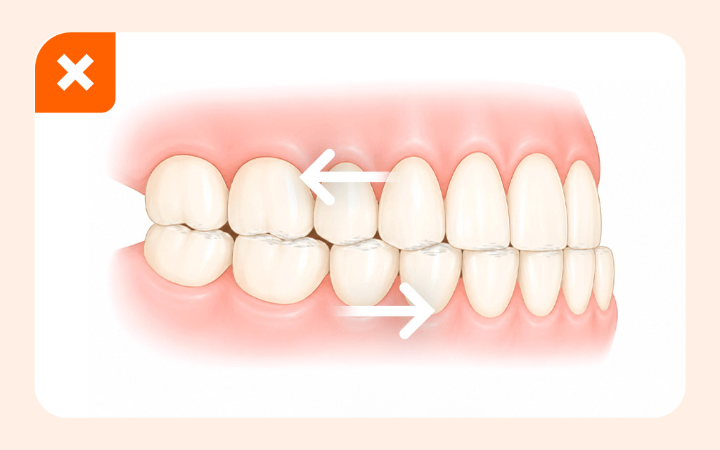 An image depicting how teeth grinding or bruxism negatively impacts veneer longevity