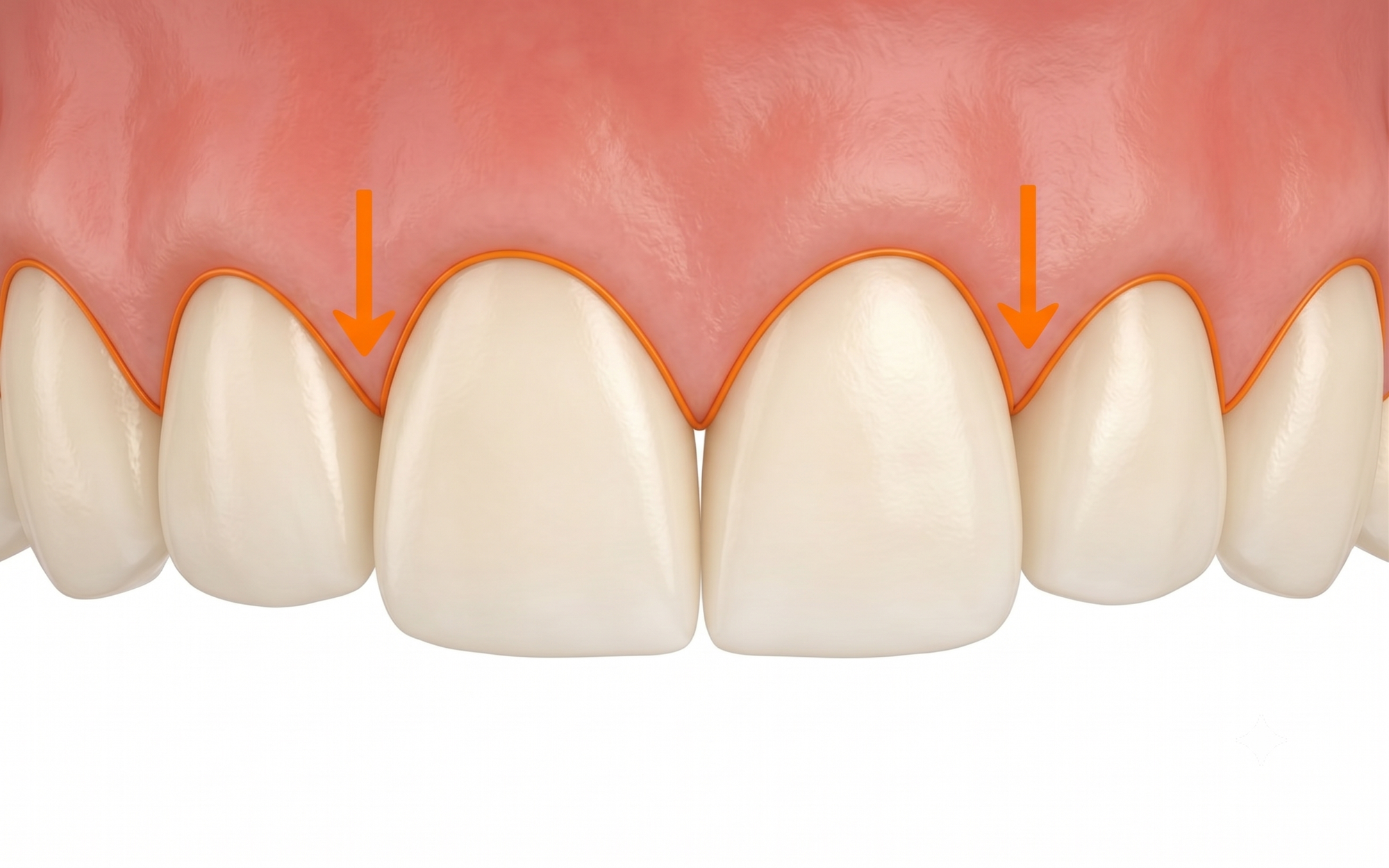An illustration displaying the anatomical margin of the gingival line