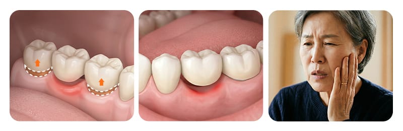 An infographic showing 3 major cases and causes of a loose dental bridge