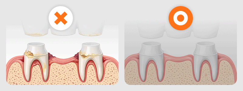 An image comparing cases where dental bridge repair or remaking is possible versus impossible