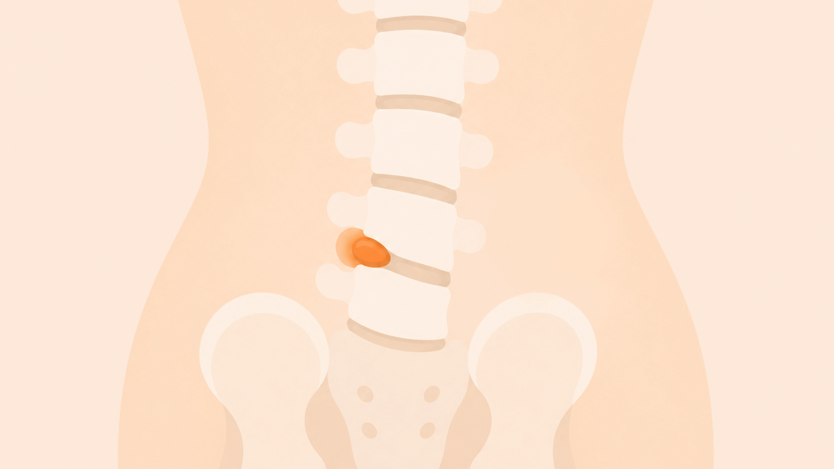 An illustration of a lower back with a herniated disc highlighting emergency red flag signs
