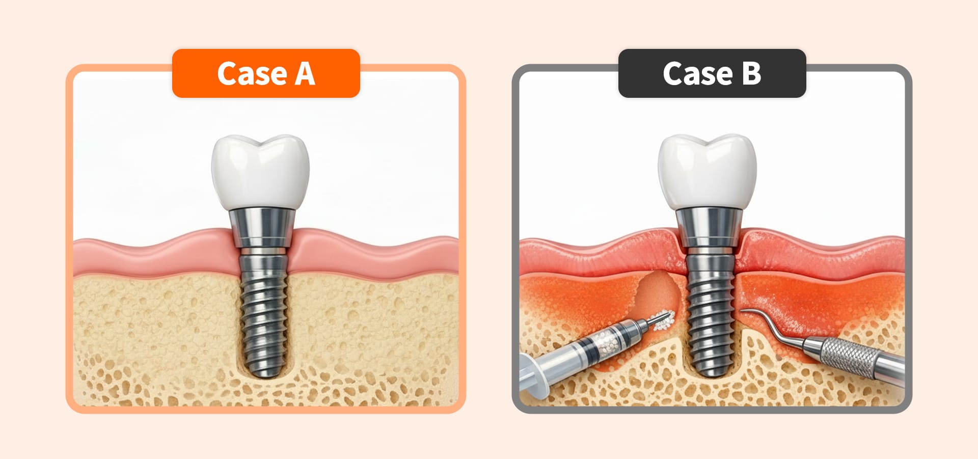Diagram illustrating the total cost structure of dental implants, combining covered items (fixture, crown) and non-covered items (bone graft, gum treatment)
