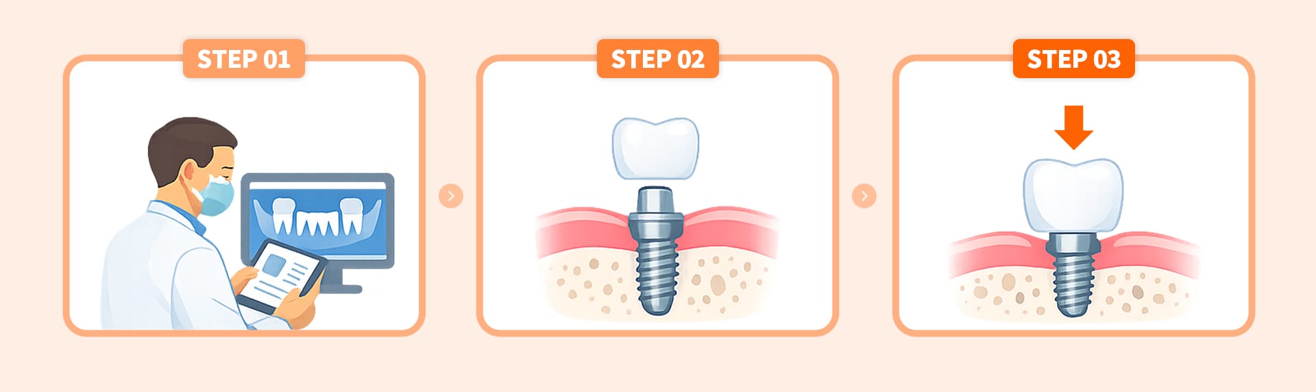 Process bar visualizing the three stages of implant treatment—diagnosis, surgery, and prosthetics—demonstrating the split payment system