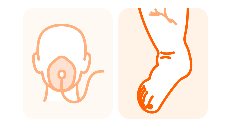 An illustration depicting myxedema coma as a thyroid medical emergency