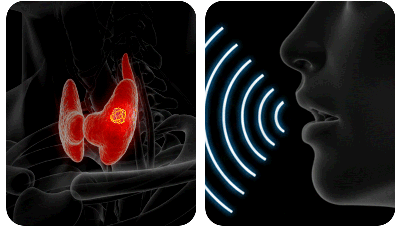 An infographic showing how a thyroid nodule can cause voice changes and hoarseness